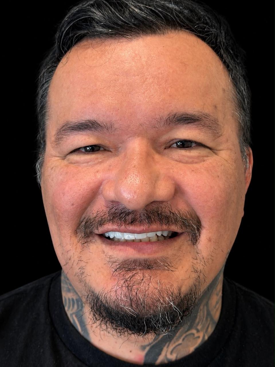 Dr. Borboa smile transformation 19